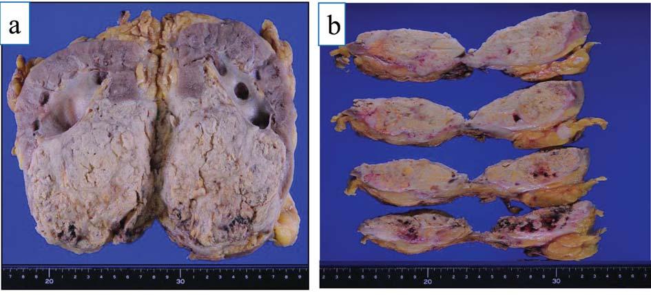 Kikuno et al: RCC Metastasis to Brain During Temsirolimus Treatment Figure 2. Gross findings of the resected kidney showed a poorly demarcated tumor from the middle portion to the lower pole (a).