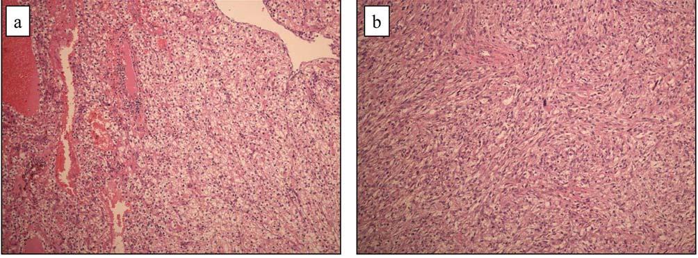 Microscopic findings (hematoxylin-eosin, reduced from 100) showed that the tumor cells were composed of clear cells (a) and spindle cells (b). metastatic cells.