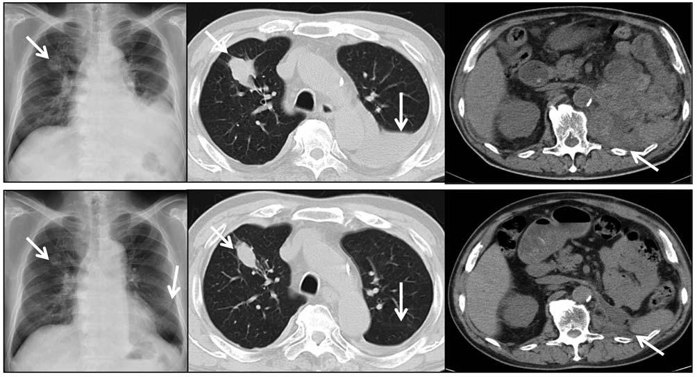 Figure 4. Chest X-ray and computed tomographic scan showing a partial response of both pleuropulmonary and locoregional lesions (arrows) after only two weeks of temsilorimus treatment.