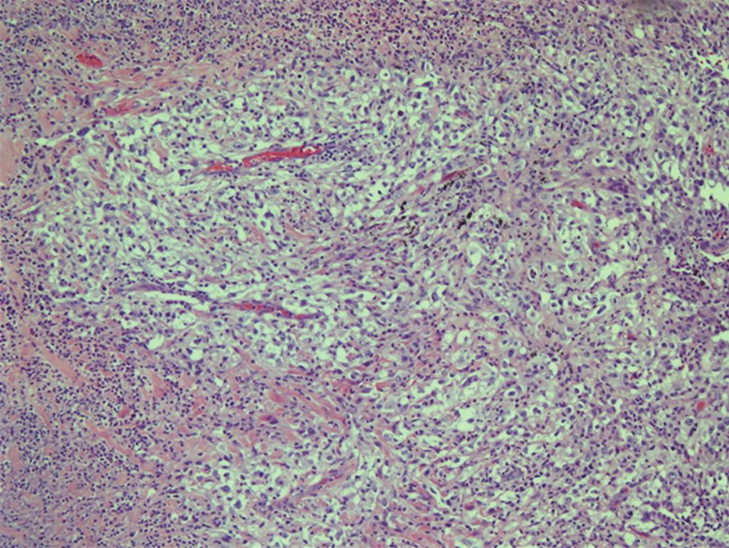 Figure 2: A high power view (40x) of pulmonary involvement by metastatic clear cell renal cell carcinoma.
