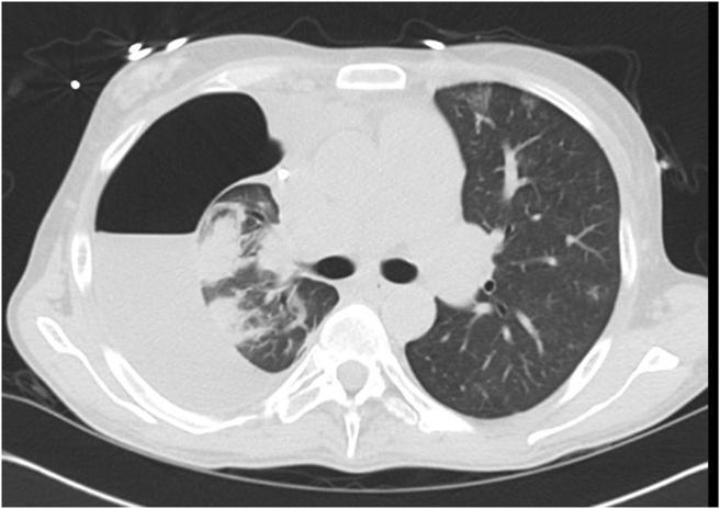 hypertension, ascites, and a persistent right-sided hepatic hydrothorax that required thoracenteses every four to six weeks.