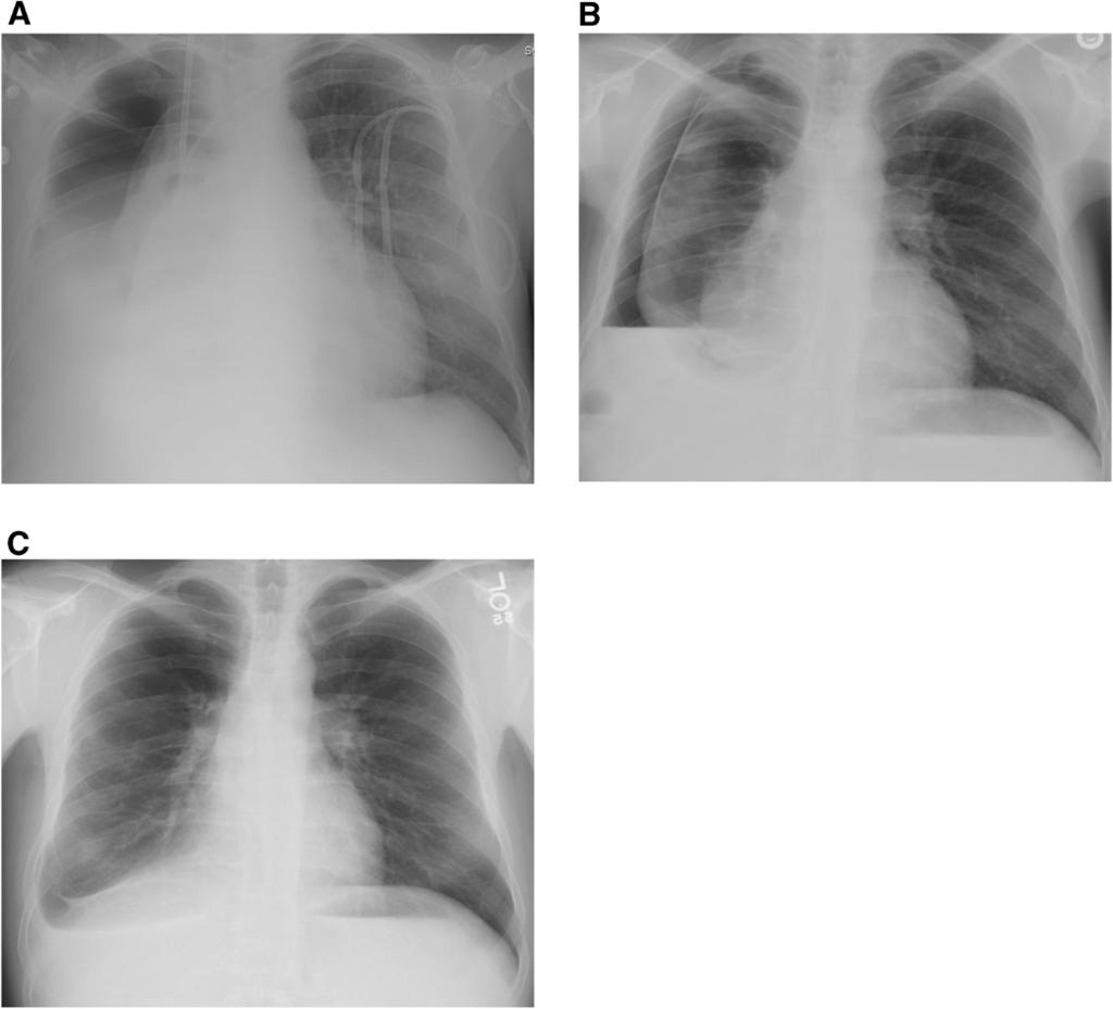 Kim et al. BMC Pulmonary Medicine 2012, 12:78 Page 3 of 6 Figure 3 Chest x-ray at discharge with a large right-sided hydropneumothorax (A).