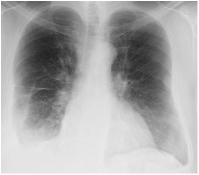 Approximately 3 months after the removal of the pleural catheter, another indwelling pleural catheter was placed by an outside hospital secondary to the patient s difficulty with tolerating diuretics.