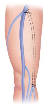 Surgery to Remove Leg Veins Sometimes, surgery is needed to remove varicose veins. If a saphenous vein needs to be removed, ligation with stripping can be done.