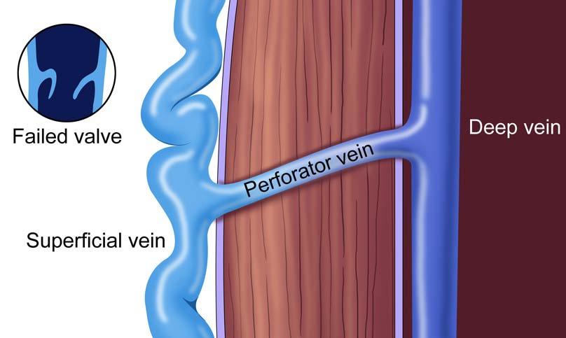 Perforator Veins Pathologic 3.5 mm in size Outward flow >500 ms duration Located beneath chronic venous stasis skin changes / ulcer Gloviczki P, et al.