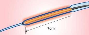 Radiofrequency Energy Delivered by the ClosureFast TM Catheter Mechanism of Action Segmental Ablation Delivered by