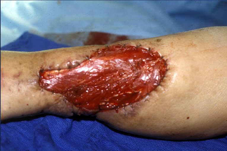 Skin-Fascia Sutured Ulcer with