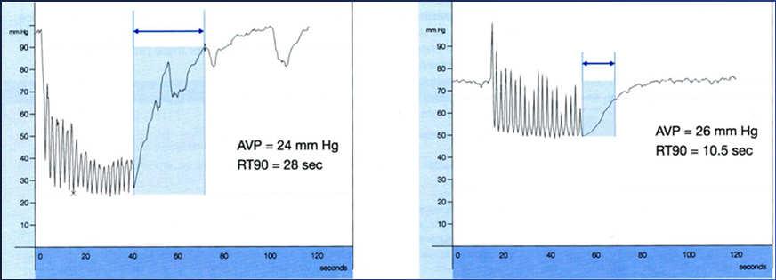 Pathophysiology Ambulatory Venous Hypertension CVD Pathophysiology Normal 30 AVP of normal Low