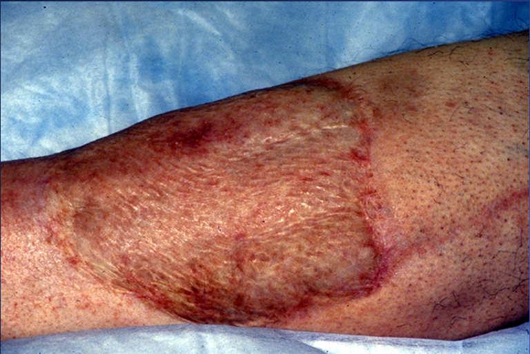 Postop Extensive Leg Ulcer 1Year