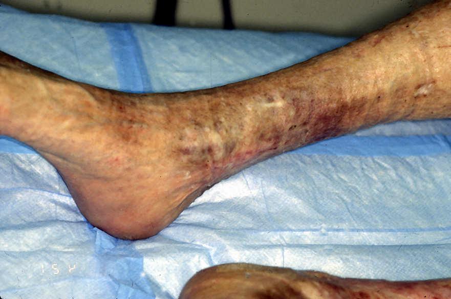 C-5 Disease Venous Ulcer Compression x 6 months Goal of Treatment Top