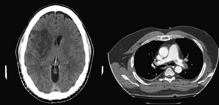 Fig 1 (Courtesy of DK) A 52-yr-old male who was admitted with a right-sided ischaemic or thrombotic stroke leading to left hemiparesis (CT brain shown), presented with acute onset chest pain 5 days