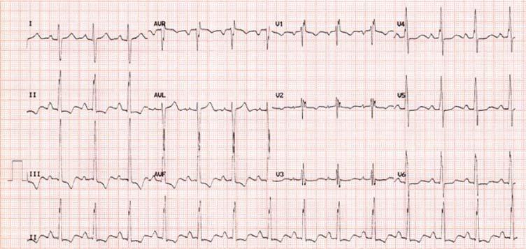 Fig 4 (Courtesy of DK) ECG in chronic thromboembolic disease showing R axis deviation, T wave inversion inferiorly and in V1 and 2, with partial right bundle branch block type pattern in the chest