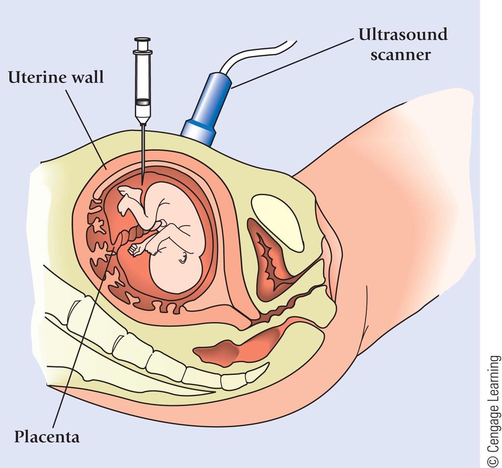 Figure 2.9 In amniocentesis, a needle is inserted through the abdominal wall into the uterus.