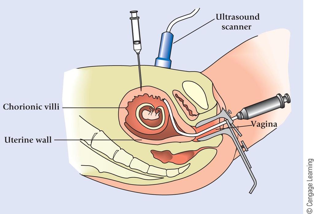 Figure 2.10 Chorionic villus sampling can be performed much earlier in pregnancy, and results are available within 24 hours.