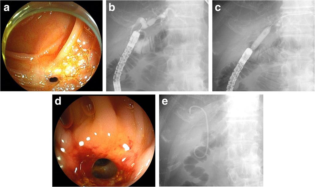Mizukawa et al. BMC Gastroenterology (2018) 18:14 Page 6 of 9 Fig. 3 Endoscopic balloon dilatation for recurrent HJAS (same case as shown in Fig. 2).