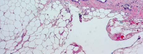 adenocarcinoma Look for tumour in nerves, LN s Vascular Margin