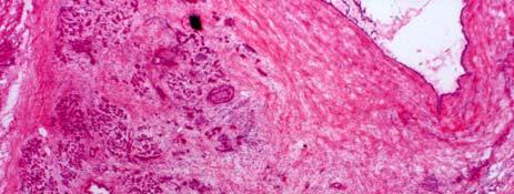 pancreatitis Tumour desmoplasia versus fibrosis