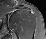 Healing of Partial-Thickness Rotator Cuff Lesions Balancing Biomechanics and Biology Steven P.