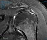 Medical - Applied Biologics Partial-thickness rotator cuff tears represent a significant challenge to the orthopaedic surgeon.