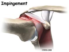 Why don t these tears heal?? While the biologic potential for healing may exist, other factors may adversely affect this process. - subacromial impingement Why don t these tears heal?
