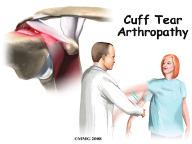 If the rotator cuff is torn and is not repaired, a type of wear and tear arthritis of the shoulder can develop over time.
