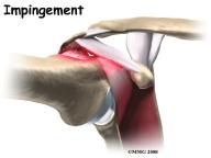The rotator cuff slides between the humeral head and the acromion as we raise our arm.