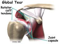 patients with rotator cuff tears. In other cases, the patient simply elects not to have surgery to repair a rotator cuff tear and chooses to simply live with the discomfort.