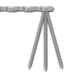Implant Specifications Reconstruction Plates Occasionally, pelvic osteosyntheses can be carried out using screws alone, but in the majority of cases lag screw fixations must be supplemented by one or