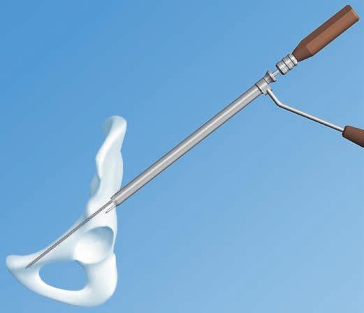 Cannulated Percutaneous Guiding System Set The Cannulated Percutaneous Guiding System is a soft tissue protector to assist in pelvic and acetabular reconstructive surgery.