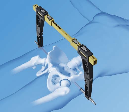 Other Available Pelvic Instruments and Implants from Synthes Pelvic C-Clamp The Pelvic C-Clamp is an emergency stabilization instrument for unstable injuries and fractures of the pelvic ring.