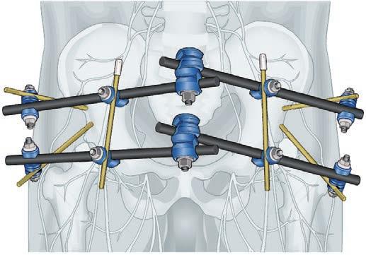 The Pelvic C-Clamp allows rapid reduction and stabilization of these unstable pelvic ring fractures, thus assisting the surgeon to gain control of the shock reaction.