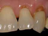 1 2 4 6 8 1 12 Tooth Brush Cycle Venus Diamond Simply great! has made it easy for me to achieve success with Minimal Invasive Dentistry.