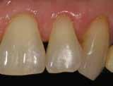 Following orthodontic treatment to correct midface collapse and increase vertical dimension a full-mouth composite addition rehabilitation was undertaken.