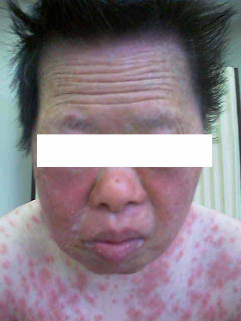 Drug rash with eosinophilia and systemic symptoms (DRESS) Hypersensitivity syndrome Onset: 2-6 weeks after Inability to detoxify