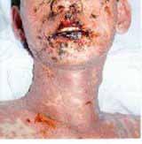 Stevens-Johnson Syndrome Clinical Features: Prodrome URI 1-14 days: symmetric red macules,