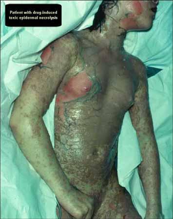 Toxic Epidermal Necrolysis Lyell s syndrome At risk: women, elderly, slow