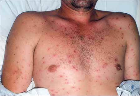 HERPES ZOSTER Varicella-zoster virus, herpes type 3 Varicella