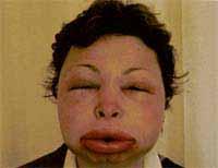 Angioedema Edema of deep dermal, subcutaneous, or submucosal tissues Pale or pink subcutaneous