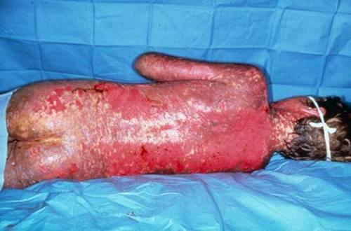 TOXIC EPIDERMAL NECROLYSIS Lesion: tender, red areas of skin often on dependent areas (lower back and butt) but can be anywhere May blister or simply slough and show + Nikolsky sign Widespread,