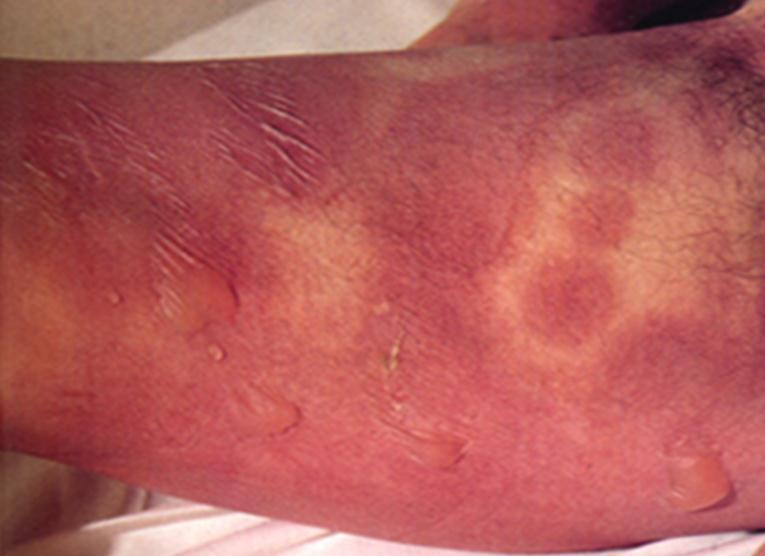 STEVENS JOHNSON SYNDROME Lesion: atypical and