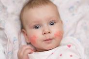 effects Reduced eczema in infants Mechanism unknown Cochrane Database Syst Rev. 2013 Mar 28;(3) Clin Exp Allergy. 2009 Apr;39(4):518-26.