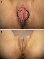 Incisions are made parallel to the long axis of the clitoris, on the fold between the minora and majora, thus leaving the clitoris more exposed, but maintaining a midline position relative to both