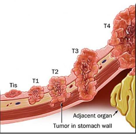 Adjuvant FOLFOX in stage II colon cancer: MOSAIC trial Outcome FU-based chemo (%) FOLFOX (%) P value 5-year DFS 79.9 83.7 0.258 6-year OS 86.8 86.9 0.