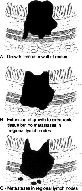 Rectal Cancer History Staging 1926 Lockhart Mummery proposed a staging system based on depth