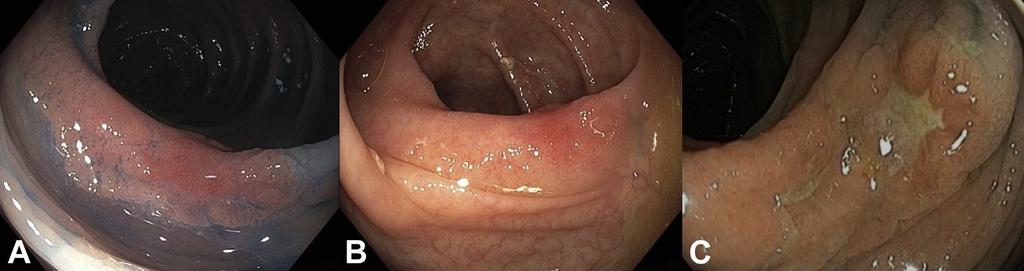 Targeted Chromoendoscopy A. 3 cm, nonpolypoid, superficial, elevated lesion after chromoendoscopy B.