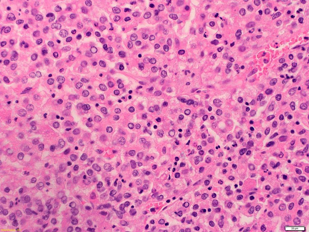 Solid pattern HCC with solid pattern The pattern is basically trabecular but the tumor cells