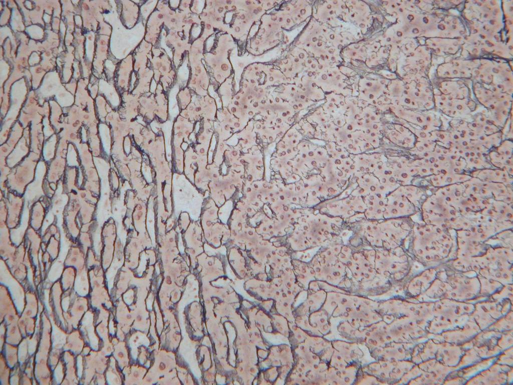 Reticulin The reticulin framework is preserved in the non-neoplastic