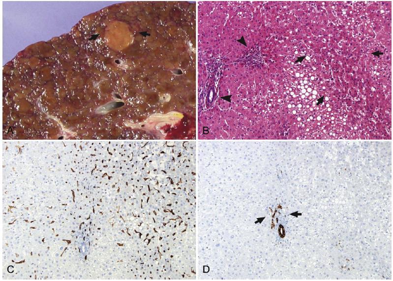 High grade dysplastic nodule Clonal cel population with architectural atypia, No stromal invasion Increased cell
