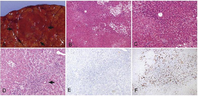 Early HCC <2cm Ø Slowly growing tumor of vaguely nodular appearance Higher cell
