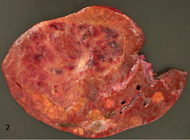 Hepatocellular Adenoma, Macroscopy Solitary, with size to 30cm Soft white to brown and